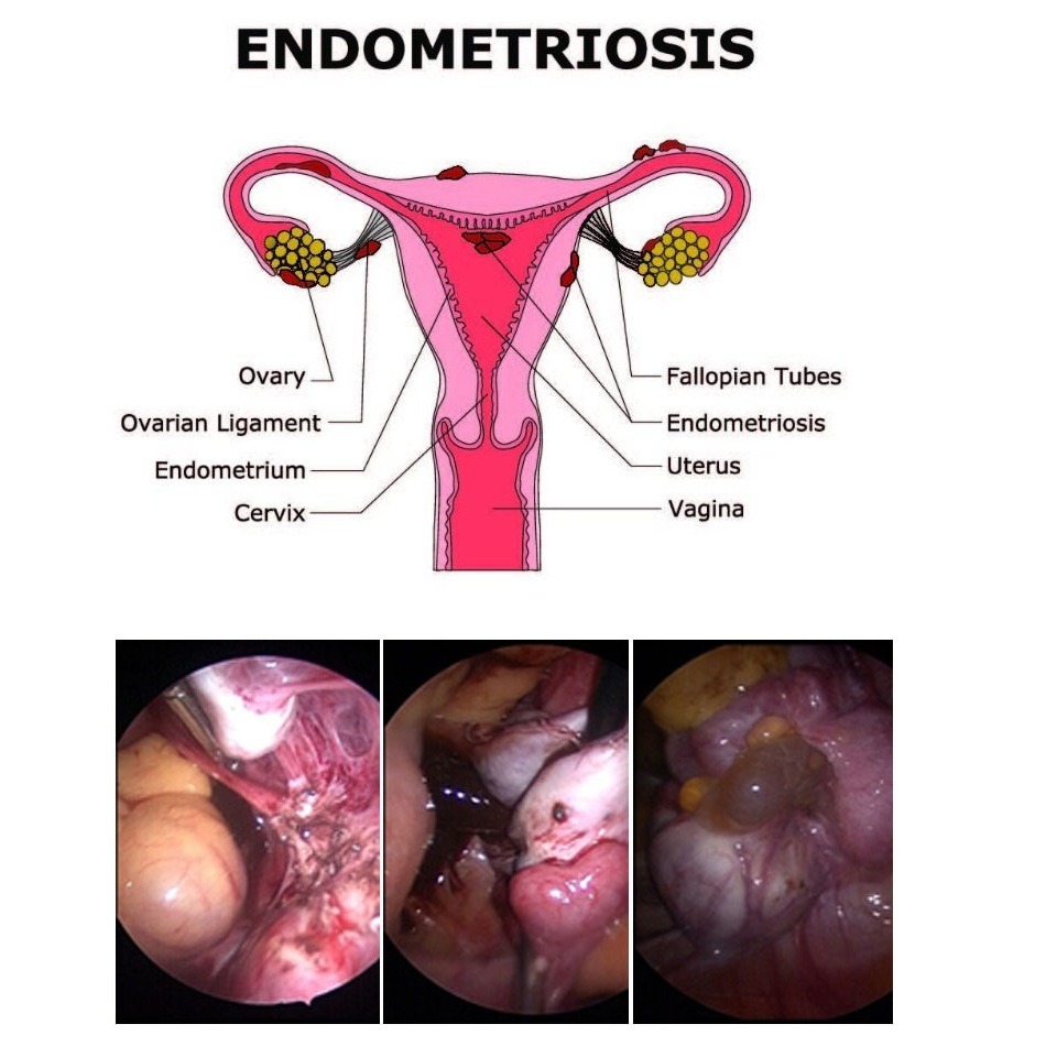 Best Endometriosis Treatment In Ghaziabad Noida